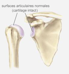 Qu’est-ce qu’une arthrose de l’épau
