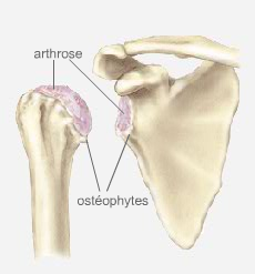 Qu’est-ce qu’une arthrose de l’épaule ?