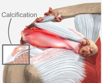 Qu’est-ce qu’une calcification de l’épaule?