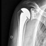 Qu’est-ce qu’une prothèse totale de l’ép